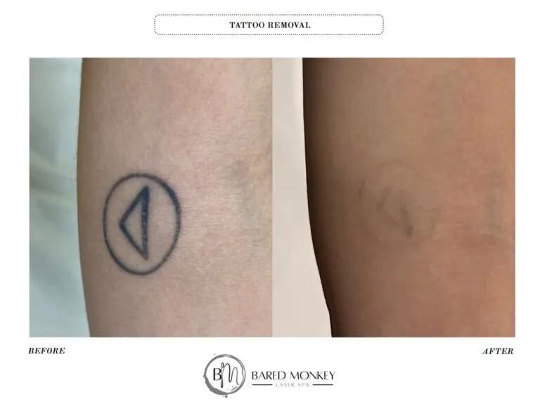 Tattoo removal result 10