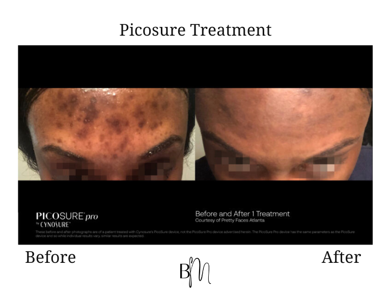 Picosure treatment result 3