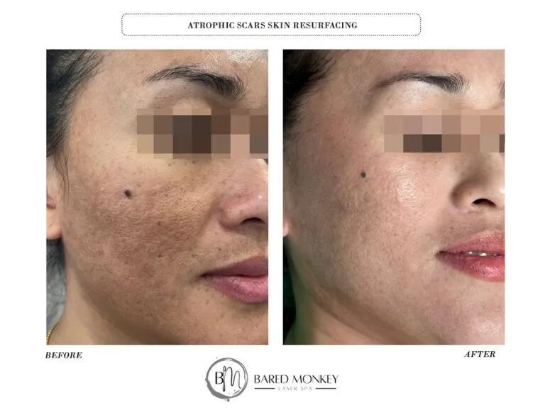 Skin rejuvenation result 10