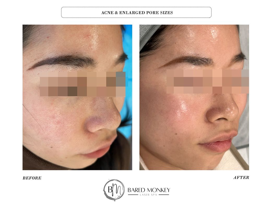 Microneedling result 1