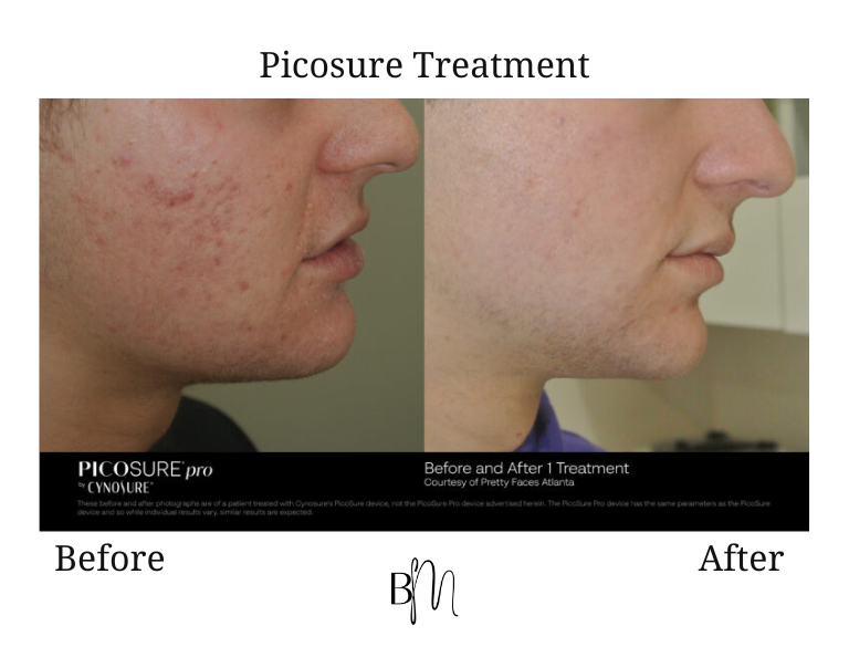 Picosure treatment result 1