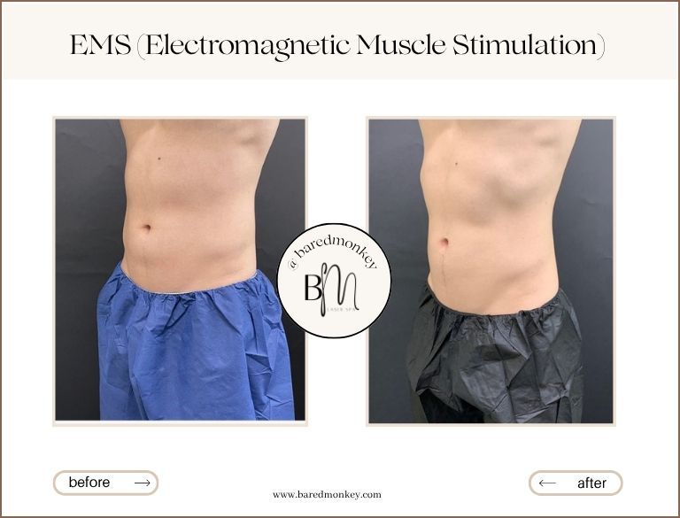 EMSculpt NEO®