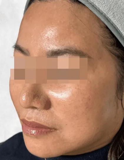 After fine line treatment