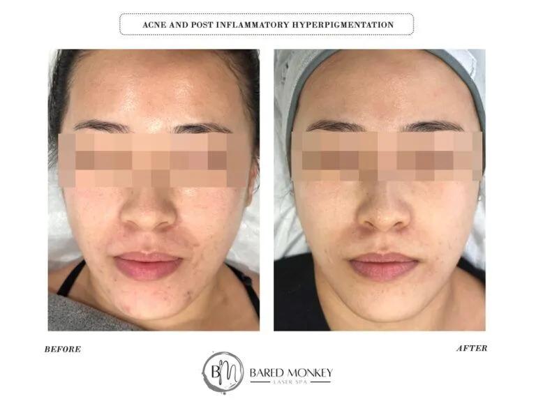 Skin rejuvenation result 23