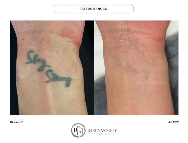 Tattoo removal result 2