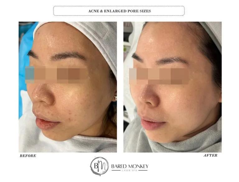 Skin rejuvenation result 11