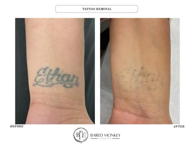 Tattoo removal result 9