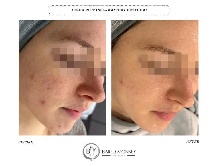 Skin rejuvenation result 18