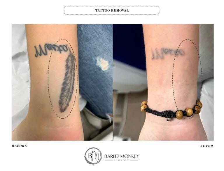 Tattoo removal result 1