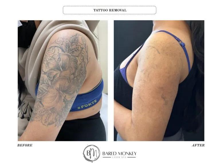 Tattoo removal result 11
