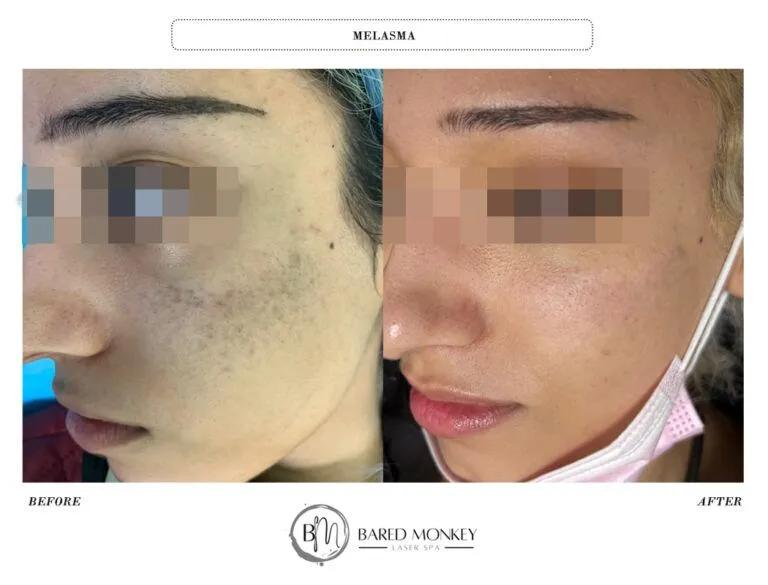 Skin rejuvenation result 34
