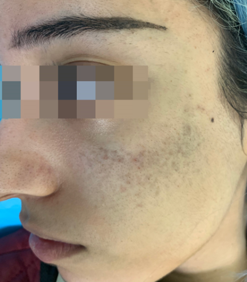 Before PicoWay session