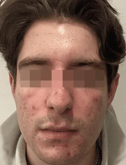 Before AviClear skin clarity