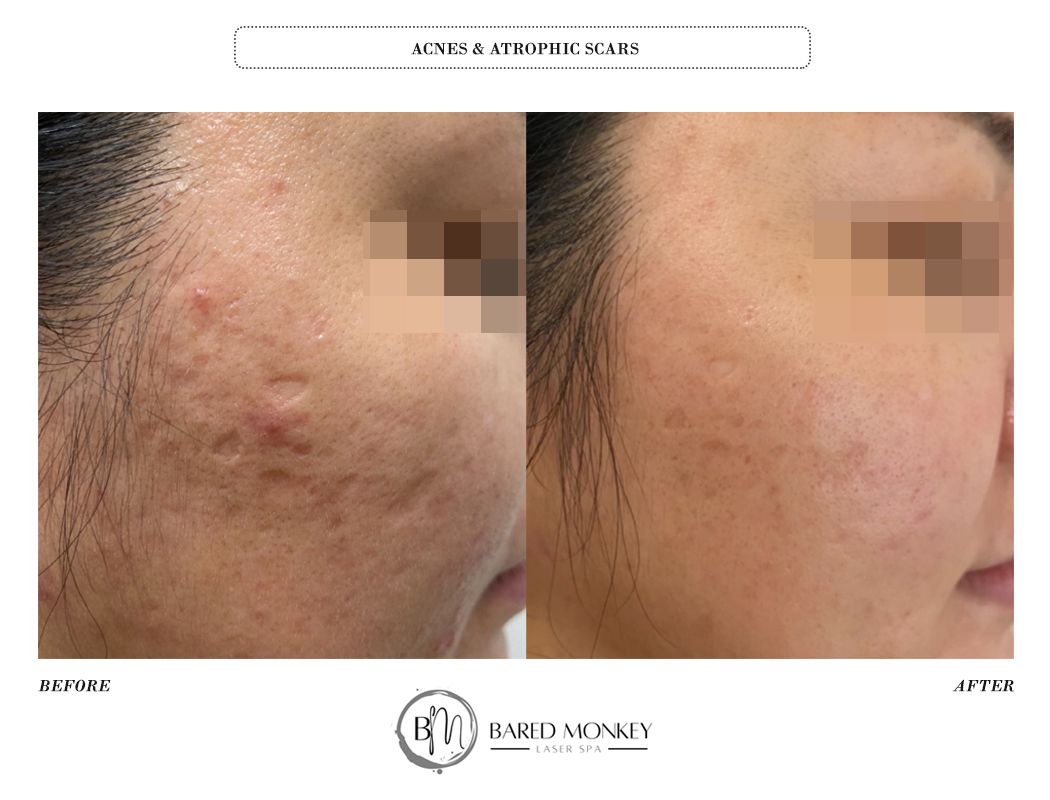 Microneedling result 5