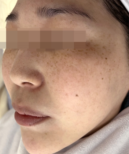 Before PicoWay treatment