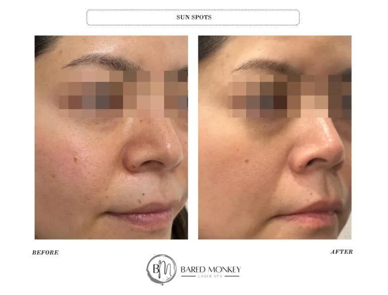 Skin rejuvenation result 40