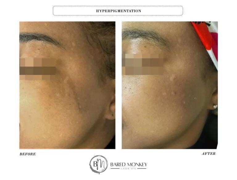Skin rejuvenation result 31