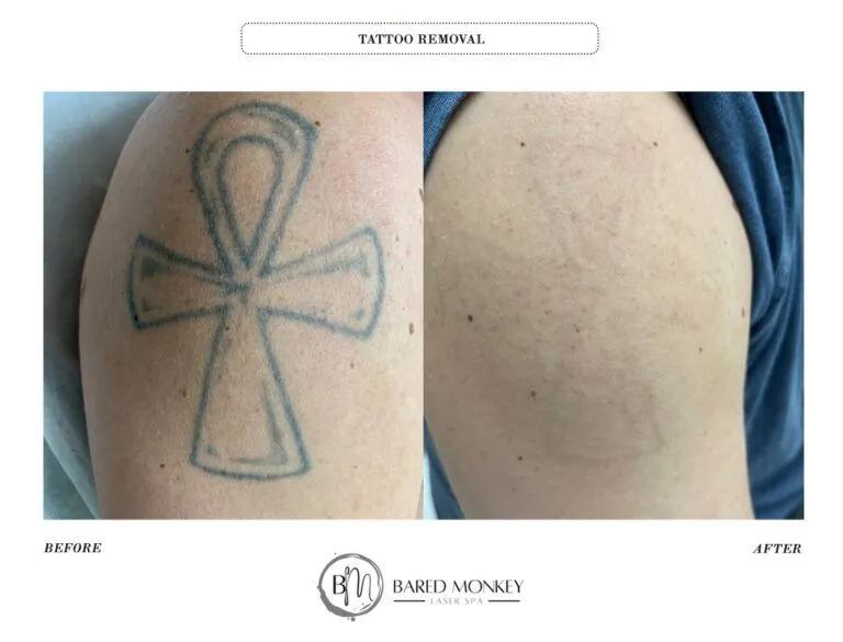 Tattoo removal result 15