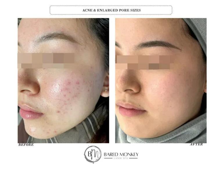 Skin rejuvenation result 14