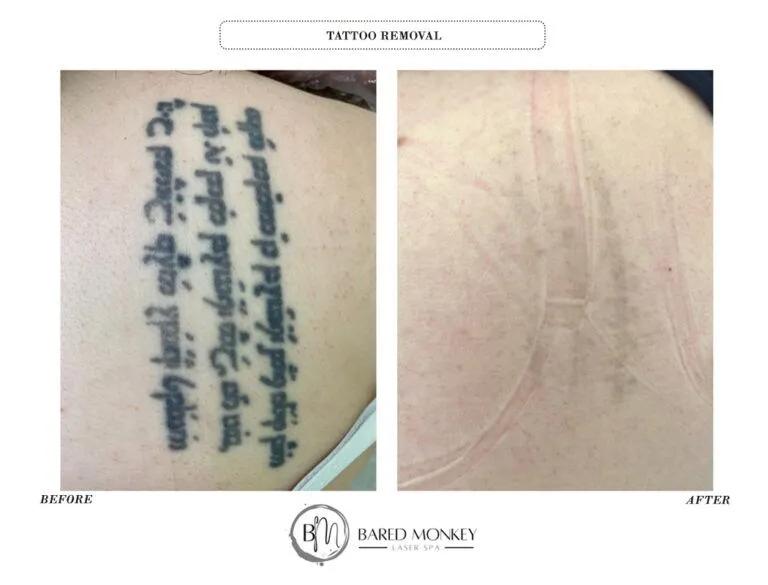 Tattoo removal result 8