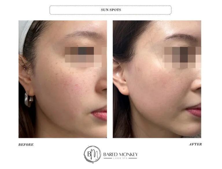 Skin rejuvenation result 39