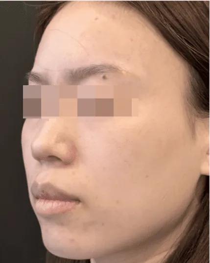 After photofacial results
