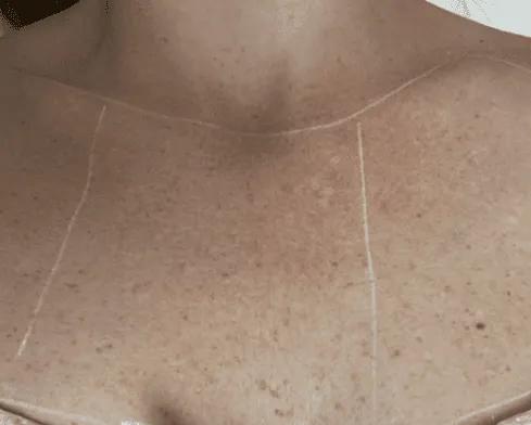 Before IPL photofacial improvement