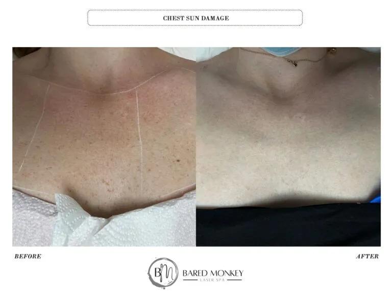 Skin rejuvenation result 26