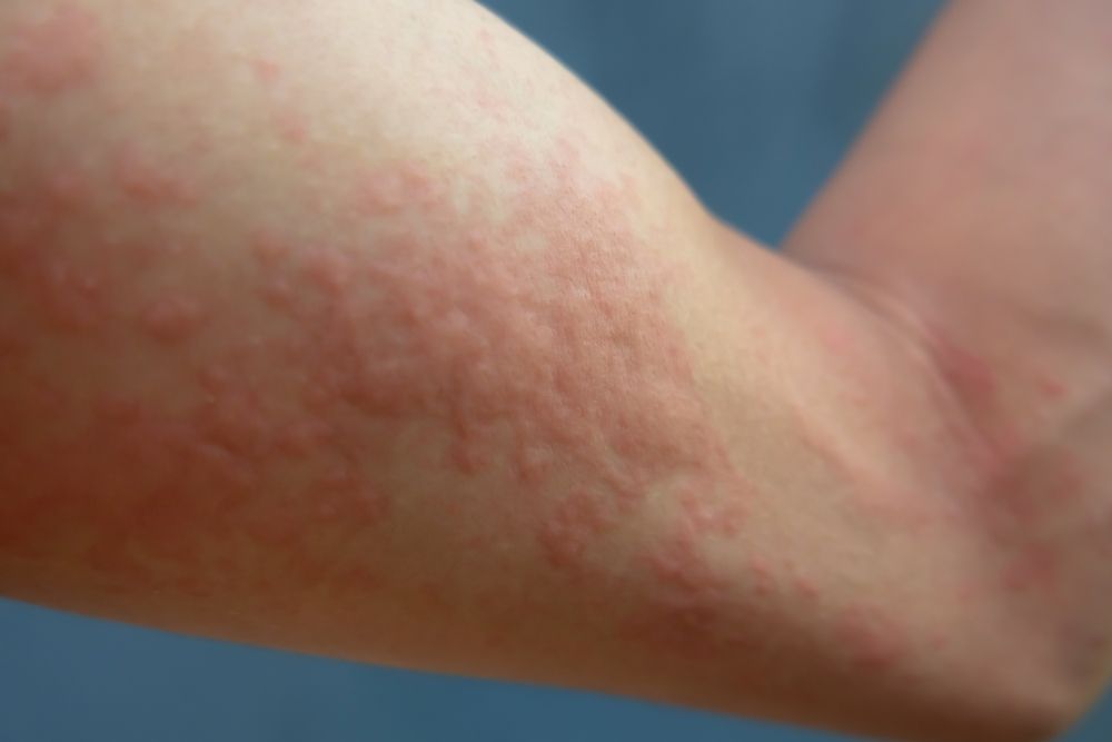 Laser Hair Removal Side Effects and Skin Care Tips