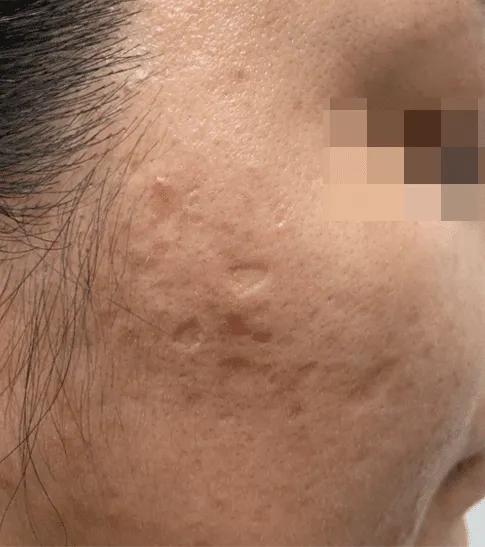 Before acne scar treatment