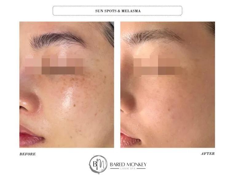 Skin rejuvenation result 41