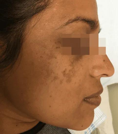 Before melasma treatment