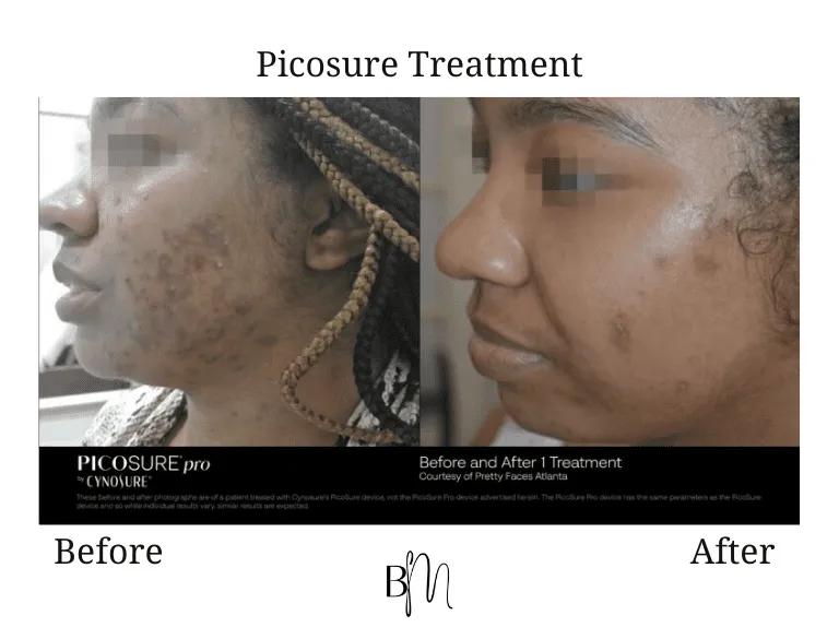 Picosure treatment result 9
