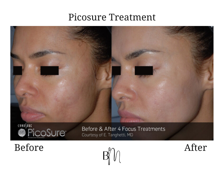 Picosure treatment result 2