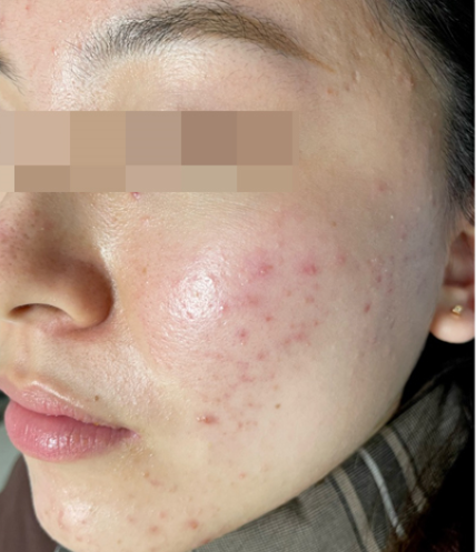 Before IPL photofacial results