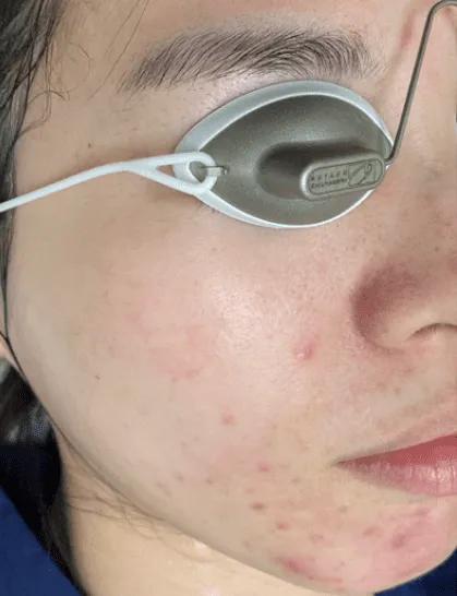 Before Picosure Pro recovery