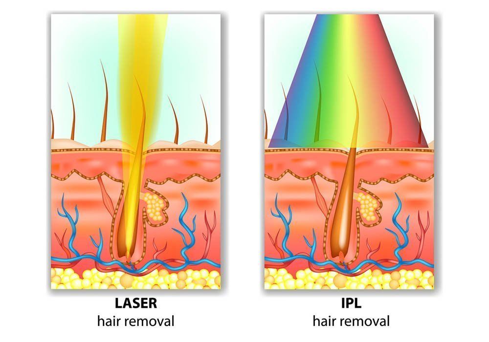 Laser Hair Removal vs. IPL Hair Removal
