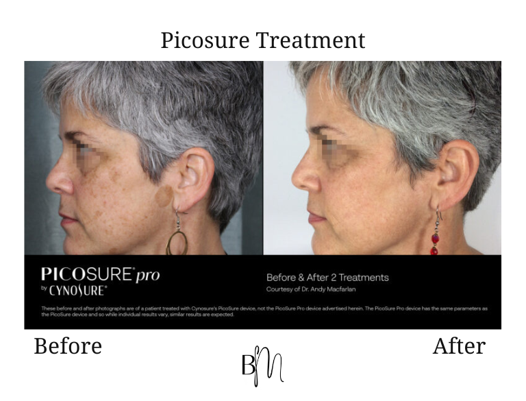 Picosure treatment result 8