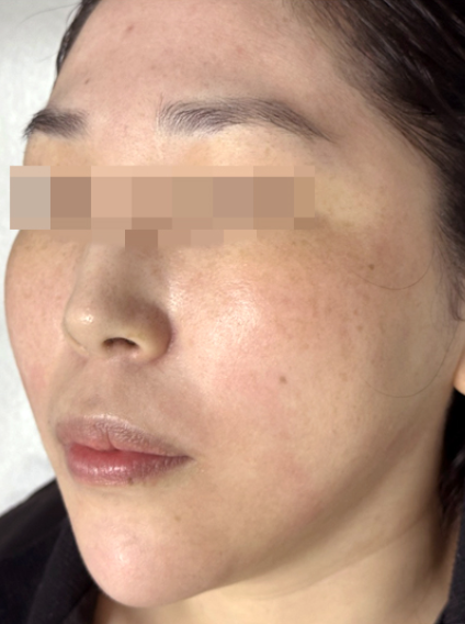 After PicoWay treatment