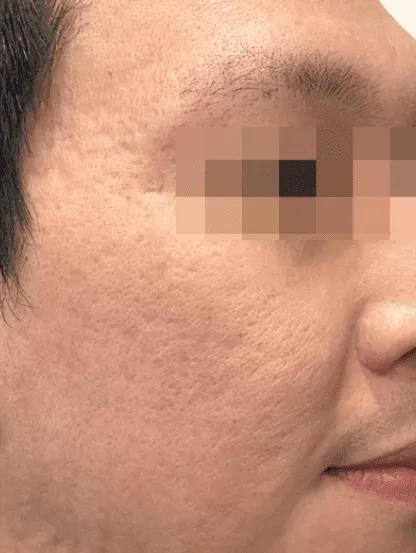 After microneedling results