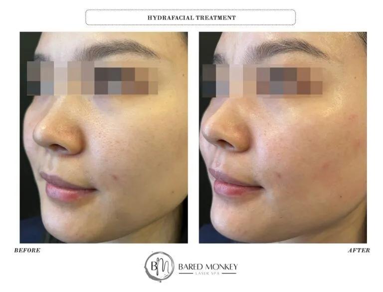 Skin rejuvenation result 29
