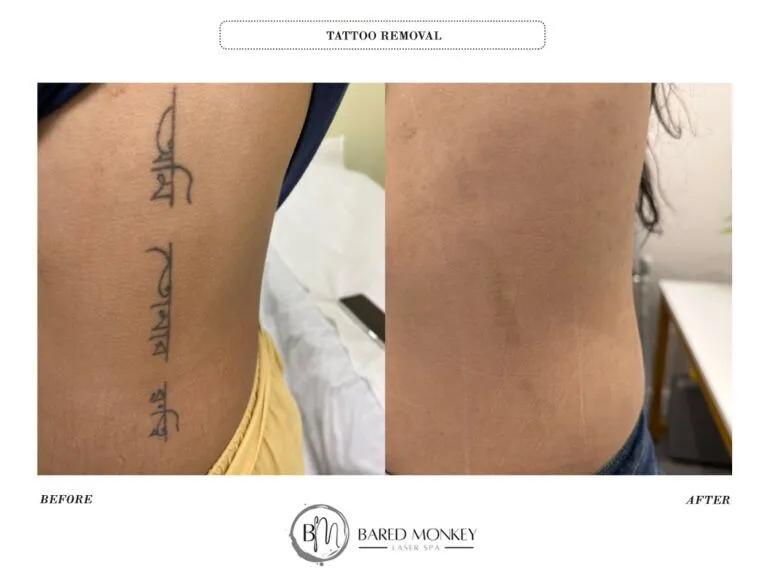 Tattoo removal result 13