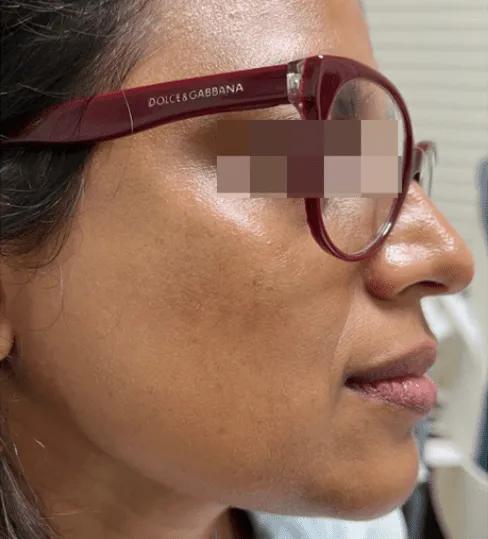 After melasma treatment