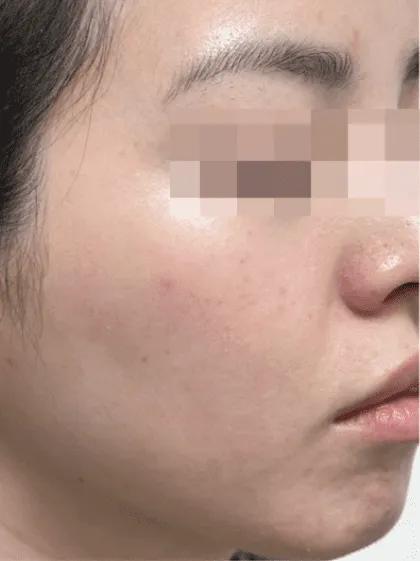 After Picosure Pro recovery