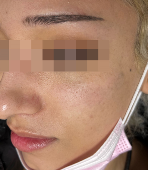 After PicoWay session