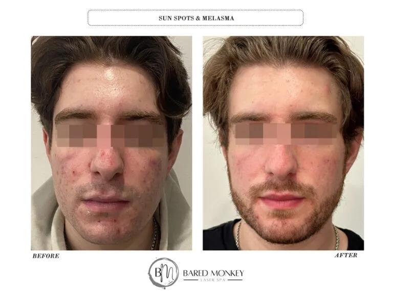 Skin rejuvenation result 20