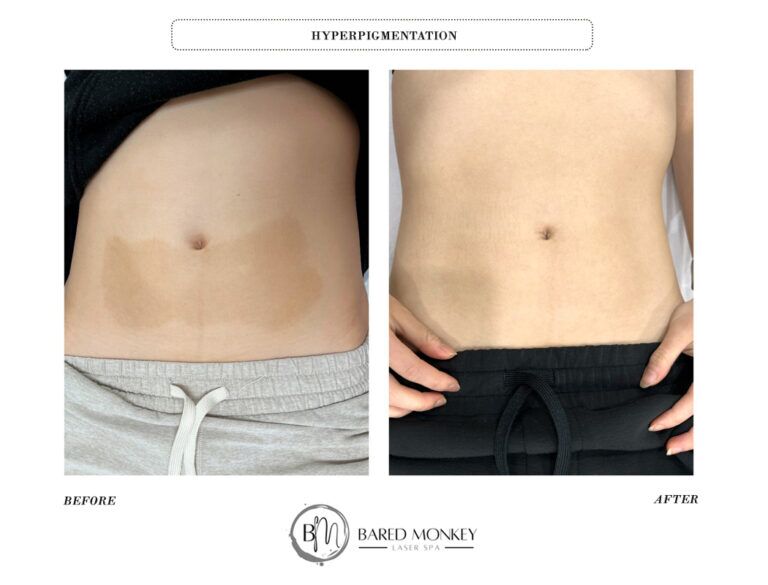 Skin rejuvenation result 30