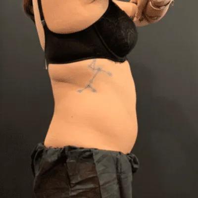 Before CoolSculpting treatment