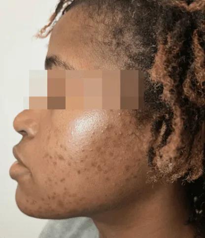 Before post-inflammatory pigmentation treatment