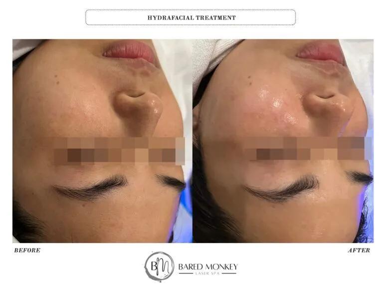 Skin rejuvenation result 27
